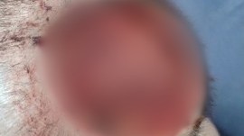 Adolescente com autismo espera por cirurgia com ferida exposta na cabeça